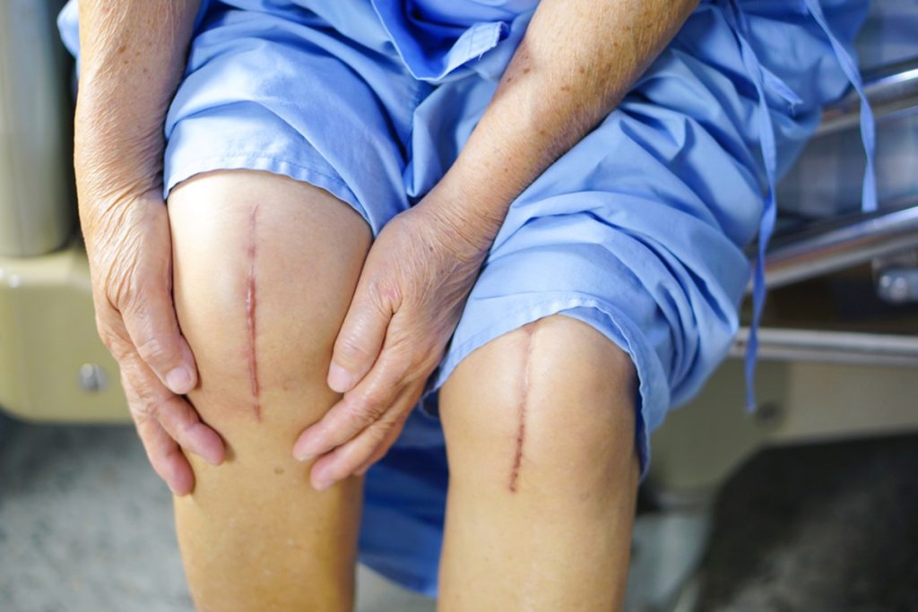 The Truth About Knee Replacement Surgery & Recovery Time