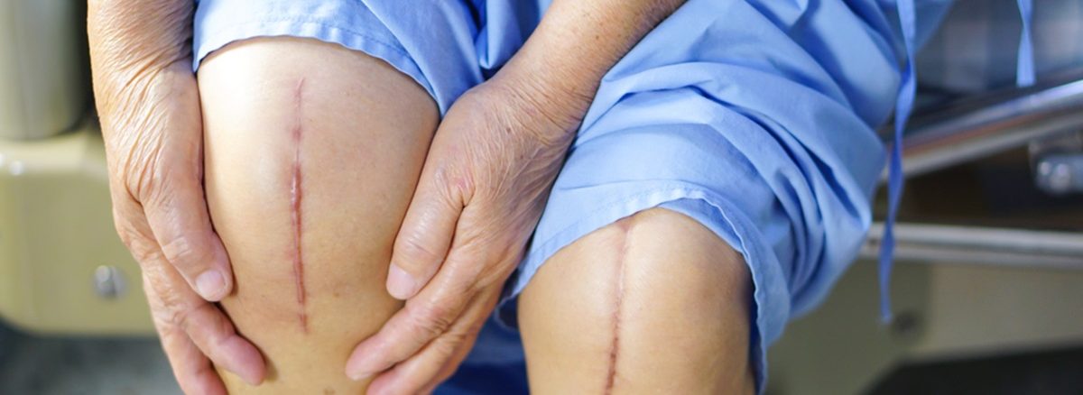 The Truth About Knee Replacement Surgery & Recovery Time