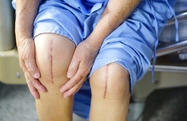 The Truth About Knee Replacement Surgery & Recovery Time