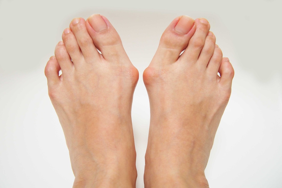 Living with Hammertoes