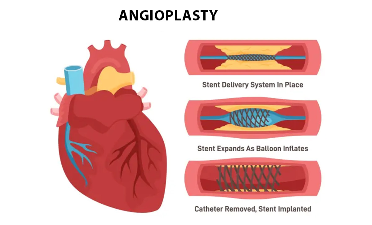 Alternatives to Angiogram and Angioplasty